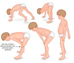El mal de Duchenne, la enfermedad genética más amenazante y ...