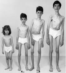 Distrofia muscular tipo Becker | medicinainterna